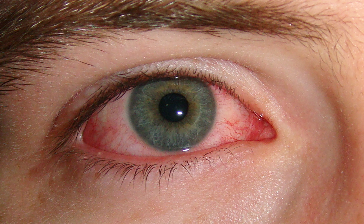 Verplicht Pat Lake Taupo Conjunctivitis: wat kan je doen tegen rode ogen? - 123 Lens Blog