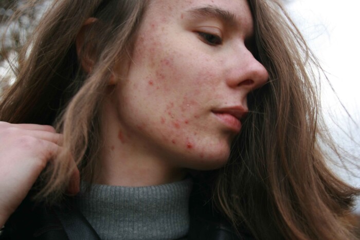 Het effect van acne medicijnen op je ogen